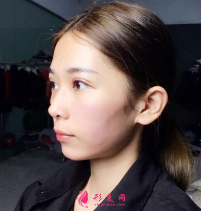 武汉韩辰整形医院李相奇双眼皮案例 武汉韩辰整形医院李相奇双眼皮案例