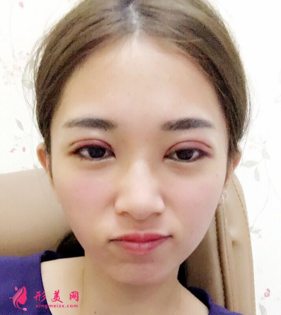 武汉韩辰整形医院李相奇双眼皮案例 武汉韩辰整形医院李相奇双眼皮案例