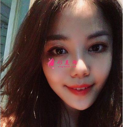 武汉韩辰整形医院樊辉华面部吸脂 武汉韩辰整形医院樊辉华面部吸脂