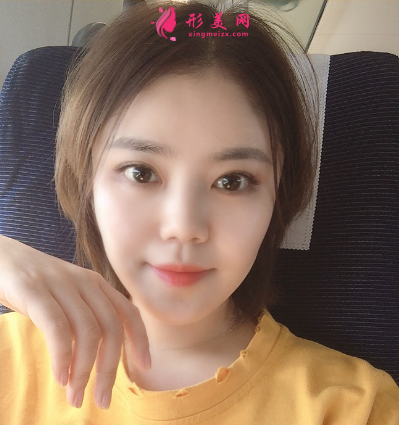 武汉韩辰整形医院樊辉华面部吸脂 武汉韩辰整形医院樊辉华面部吸脂