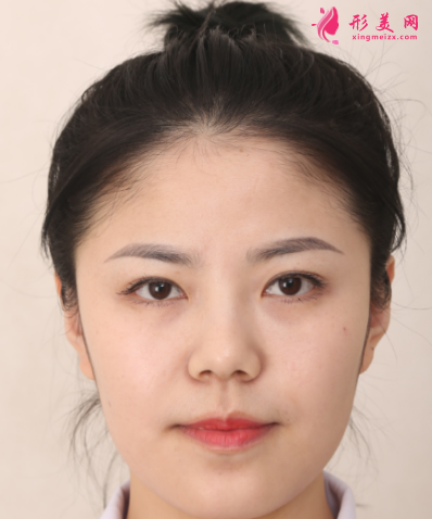 武汉韩辰整形医院樊辉华面部吸脂 武汉韩辰整形医院樊辉华面部吸脂