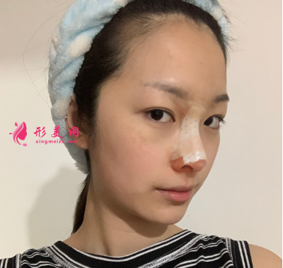 武汉韩辰整形医院牛永敢隆鼻技术 武汉韩辰整形医院牛永敢隆鼻技术