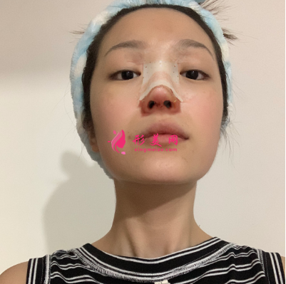 武汉韩辰整形医院牛永敢隆鼻技术 武汉韩辰整形医院牛永敢隆鼻技术