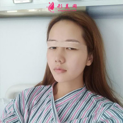 上海东方丽人整形医院吴建明双眼皮案例 上海东方丽人整形医院吴建明双眼皮案例