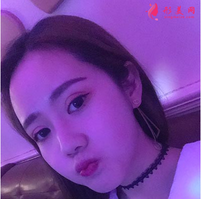 上海东方丽人整形医院吴建明双眼皮案例 上海东方丽人整形医院吴建明双眼皮案例