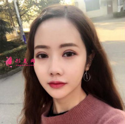 上海东方丽人整形医院吴建明双眼皮案例 上海东方丽人整形医院吴建明双眼皮案例