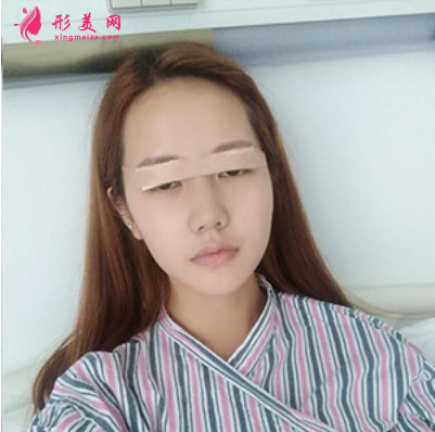 上海东方丽人整形医院吴建明双眼皮案例 上海东方丽人整形医院吴建明双眼皮案例