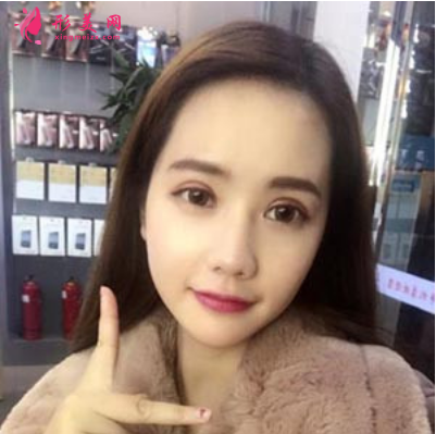 上海东方丽人整形医院吴建明双眼皮案例 上海东方丽人整形医院吴建明双眼皮案例