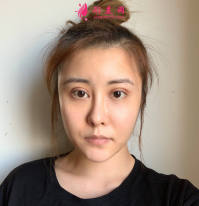 武汉米兰整形医院王楷双眼皮