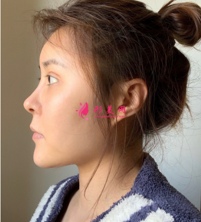 武汉米兰整形医院王楷双眼皮