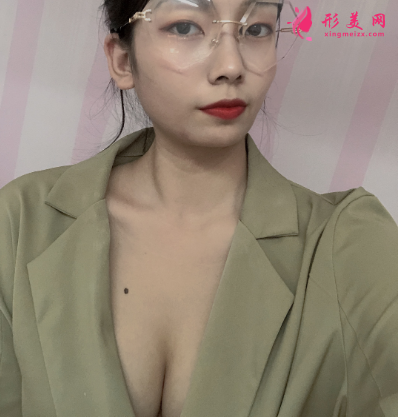 上海港华整形医院吕金陵丰胸案例