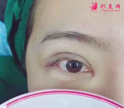 上海百达丽整形王维做双眼皮怎么样？60天术后效果对比真的好极了