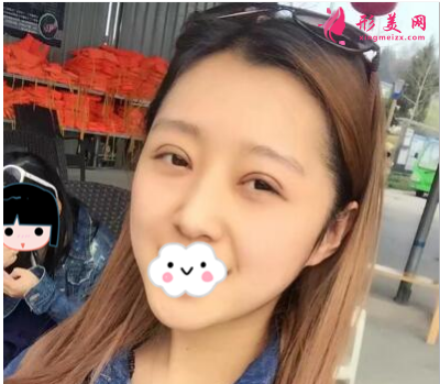 上海百达丽整形王维做双眼皮怎么样？60天术后效果对比真的好极了