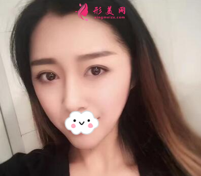 上海百达丽整形王维做双眼皮怎么样？60天术后效果对比真的好极了