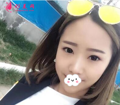 上海百达丽整形王维做双眼皮怎么样？60天术后效果对比真的好极了