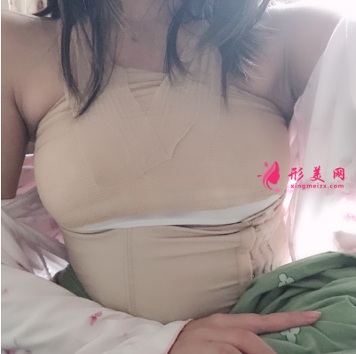 上海喜美整形医院王会勇自体脂肪隆胸案例