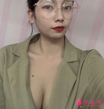 上海港华整形医院吕金陵丰胸案例 上海港华整形医院吕金陵丰胸案例