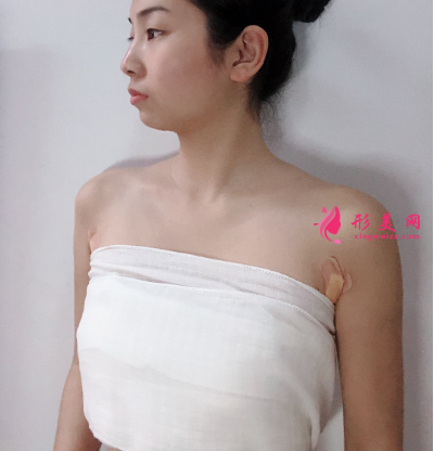 上海港华整形医院吕金陵丰胸案例 上海港华整形医院吕金陵丰胸案例