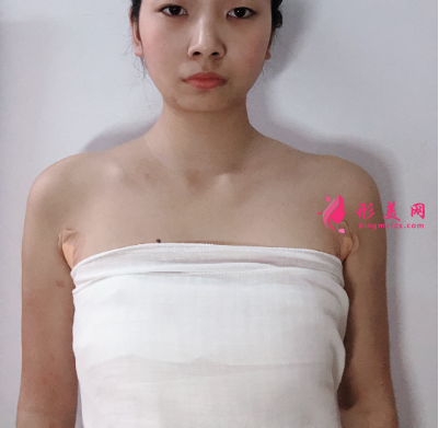 上海港华整形医院吕金陵丰胸案例 上海港华整形医院吕金陵丰胸案例