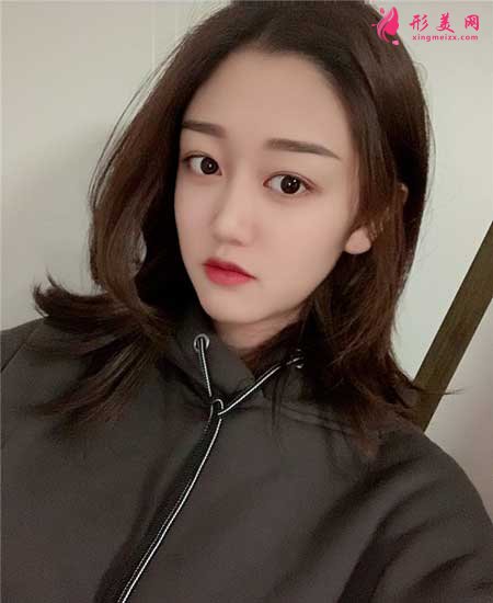 找八大处宗宪磊医生做了双眼皮手术,术后6个月恢复效果图