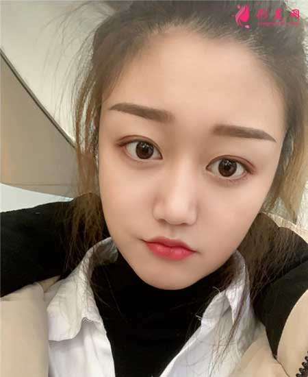 找八大处宗宪磊医生做了双眼皮手术,术后6个月恢复效果图