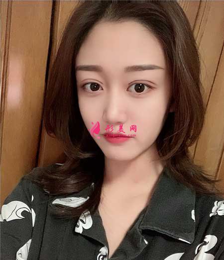 找八大处宗宪磊医生做了双眼皮手术,术后6个月恢复效果图