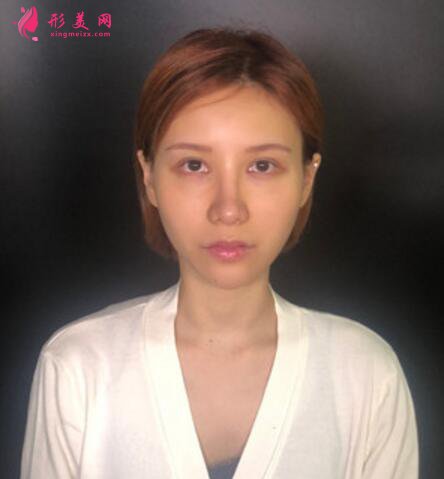 黑眼圈如何去除?填充玻尿酸泪沟+黑眼圈一步解决