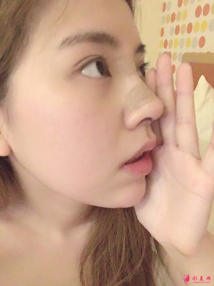 鼻头鼻翼缩小手术案例，术后恢复全记录！