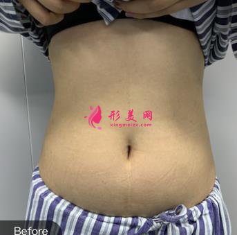 胖妞变型记:腰部吸脂术术后恢复全过程,看我72变~