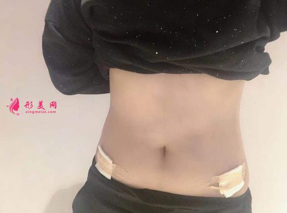 胖妞变型记:腰部吸脂术术后恢复全过程,看我72变~