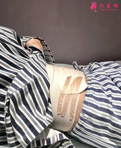 胖妞变型记:腰部吸脂术术后恢复全过程,看我72变~