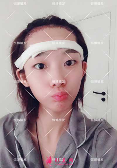 成都恒博植发术后2天图片
