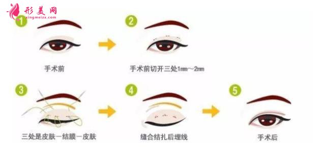 全切双眼皮痛吗?是局麻还是全麻?