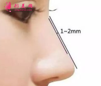自体软骨隆鼻效果好么