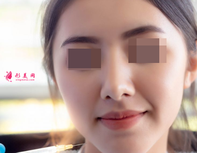 自体脂肪填充面部效果可以保持多久