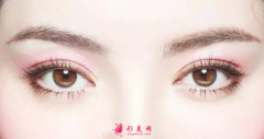 埋线双眼皮手术多久能恢复？