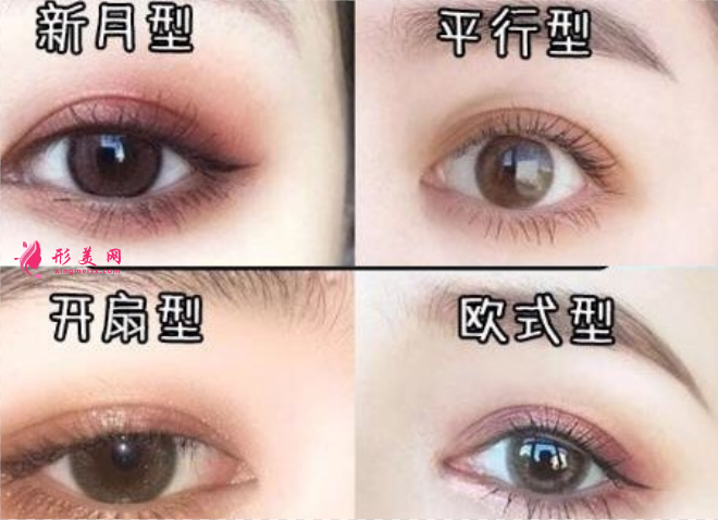 做双眼皮的形状有多少种