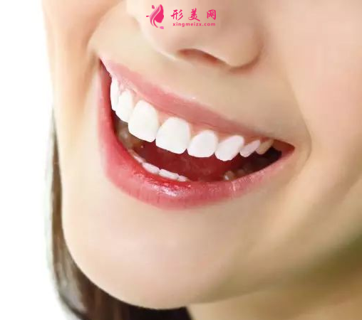 烤瓷牙要多少钱