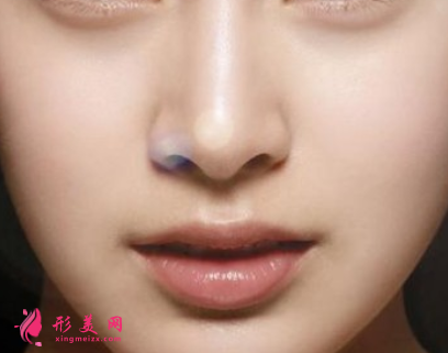 膨体隆鼻歪了怎么办