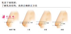 胸部下垂矫正手术多少钱？