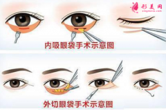 手术祛眼袋后眼眶凹陷能修复吗？