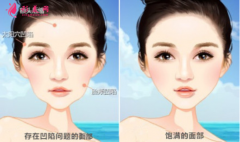 自体脂肪填充脸部可以保持多久？