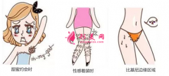 激光脱毛后要注意什么？