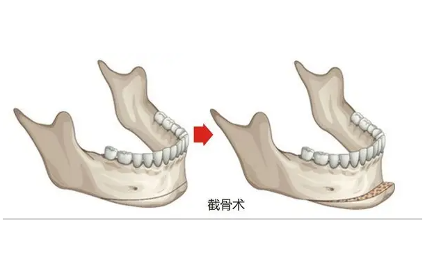 磨骨手术有什么风险？磨骨手术要选择正规医院!