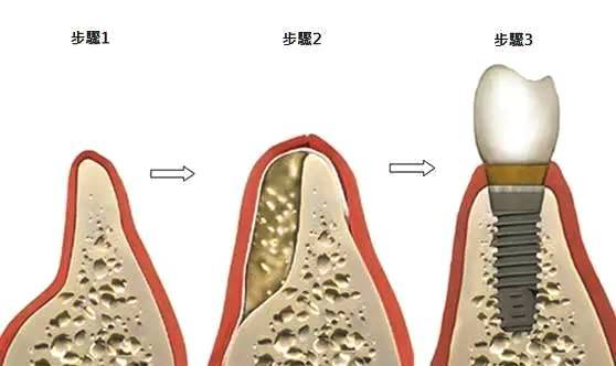 种牙好还是镶牙好区别是什么?种牙和镶牙的价格一样吗? 种牙好还是镶牙好区别是什么?种牙和镶牙的价格一样吗?