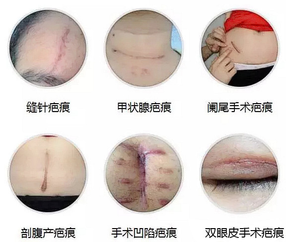 分享国内好的疤痕医院排名,快速了解疤痕修复医院哪里好? 分享国内好的疤痕医院排名,快速了解疤痕修复医院哪里好?