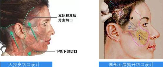 祝东升面部提升技术怎么样 祝东升面部提升技术怎么样