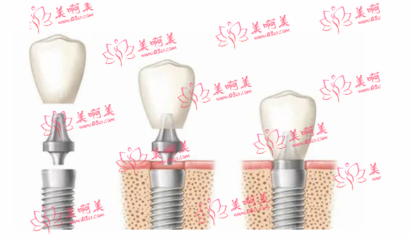 海曙口腔医院3500就可以种植牙，解决缺牙问题，不在望而却步，来看看社保种植牙是不是可以报销