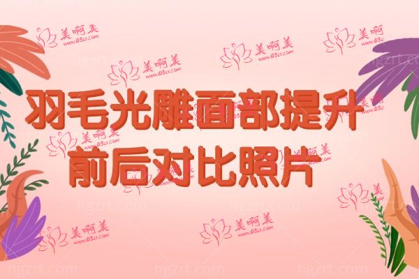 羽毛光雕面部提升.jpg 羽毛光雕面部提升.jpg