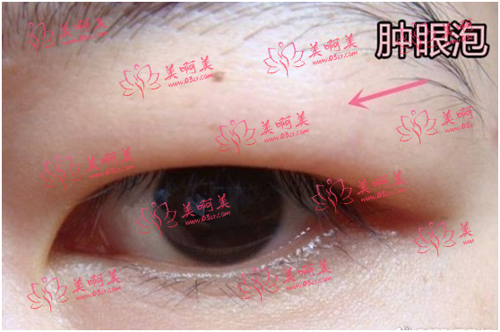想要改善眼睛浮肿该怎么办？抽脂还是埋线？